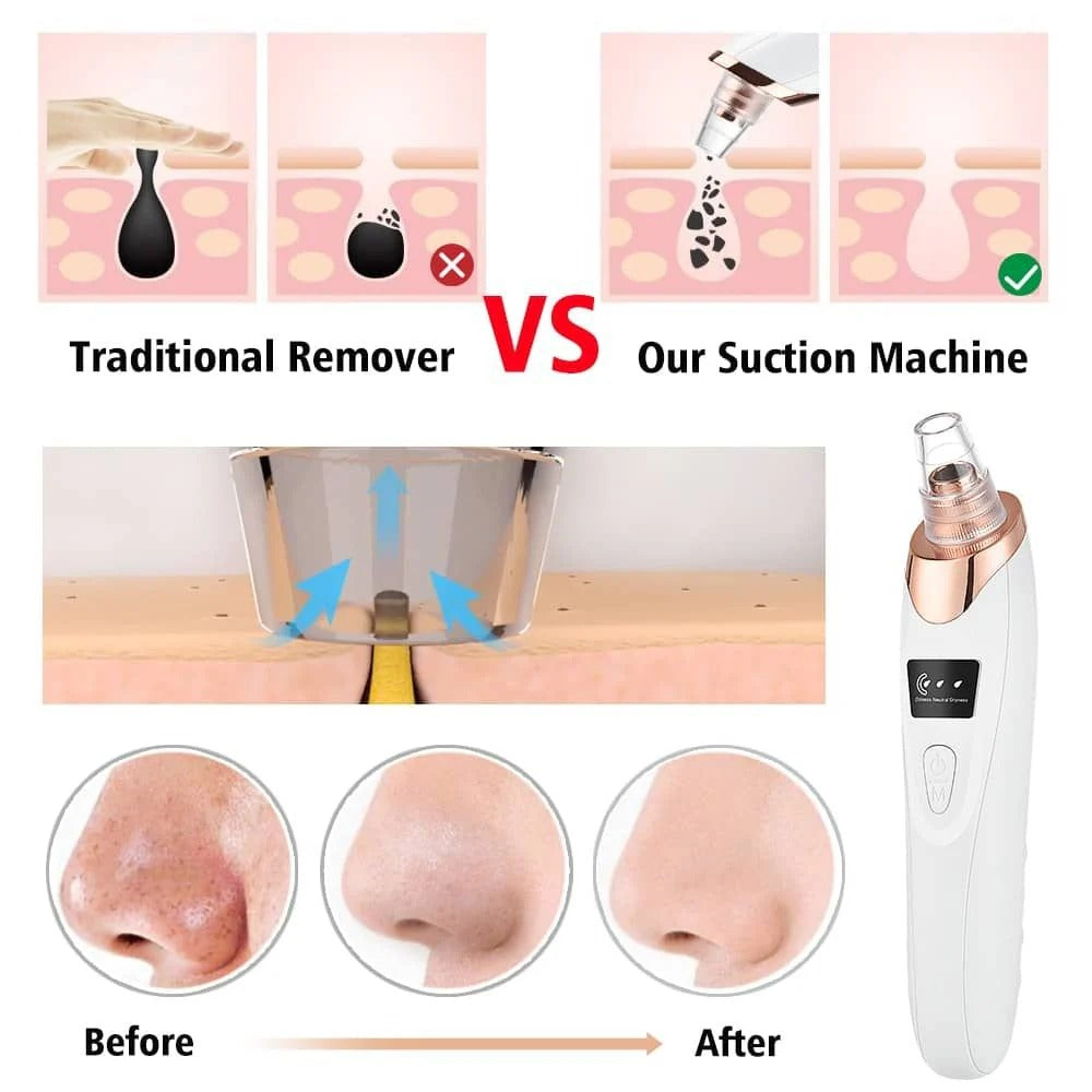 Deep Pore Cleansing Blackhead Remover – Rechargeable Skin Care Vacuum
